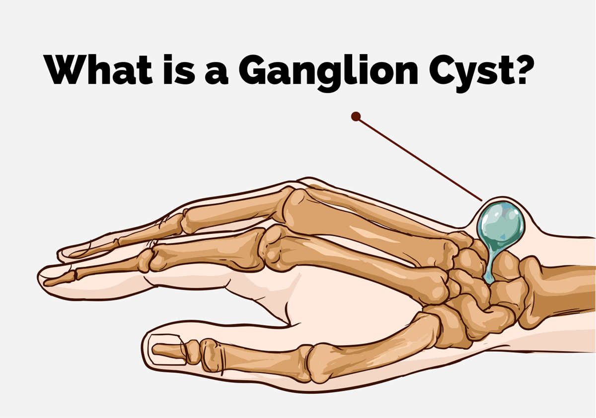 Ganglion Cyst vs Synovial Cyst Joint Cysts Explained Long Article
